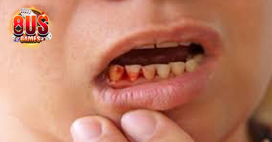 Mơ Nhổ Răng - Đây Là Điềm Báo Gì, Là Điềm Xấu Hay Điềm Tốt 8 Mơ nhổ răng bị chảy máu